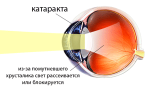 Катаракта глаз